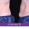 Image 3: Experience Non-Invasive Fat Reduction with TruSculpt