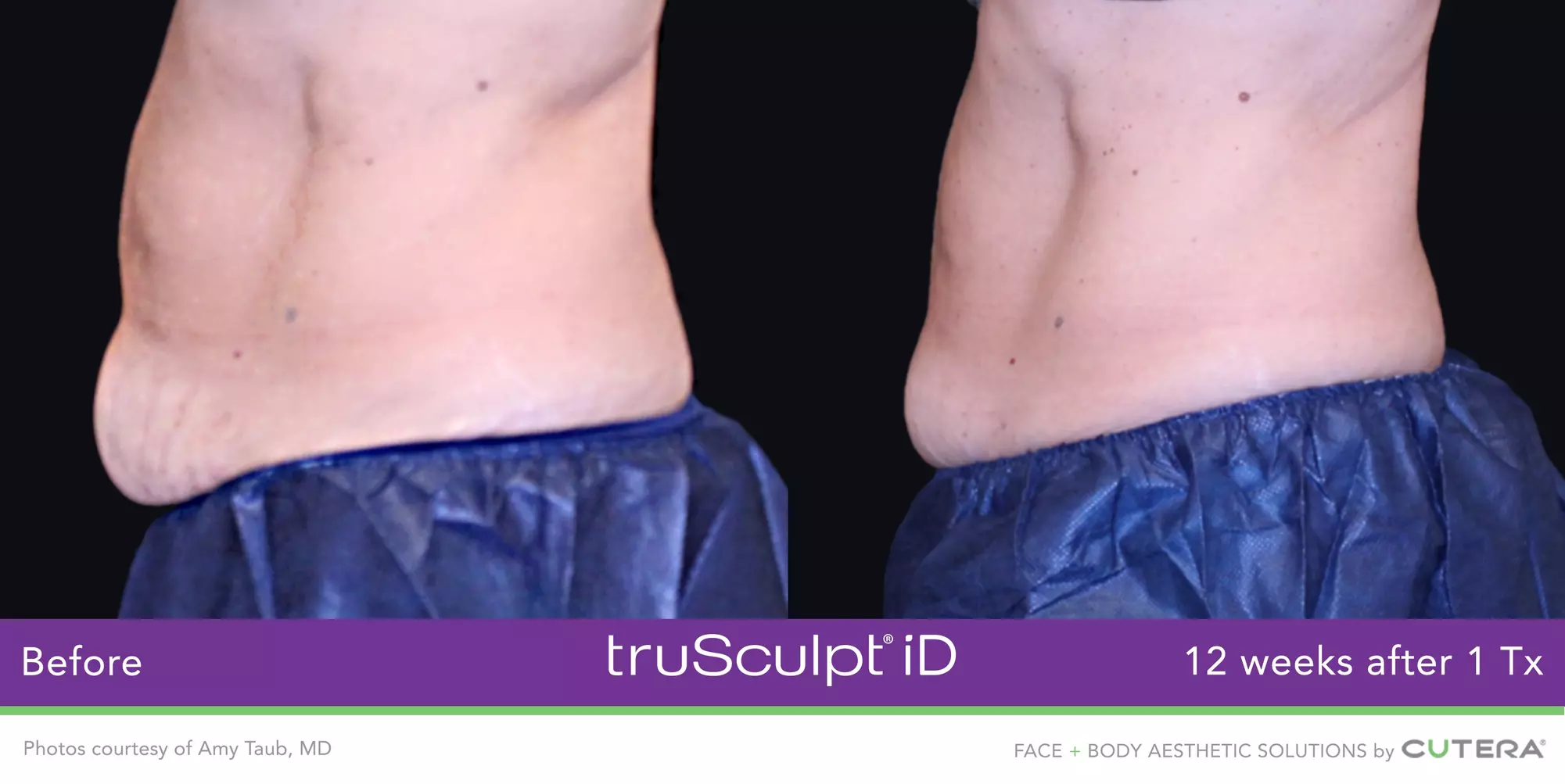 Experience Non-Invasive Fat Reduction with TruSculpt