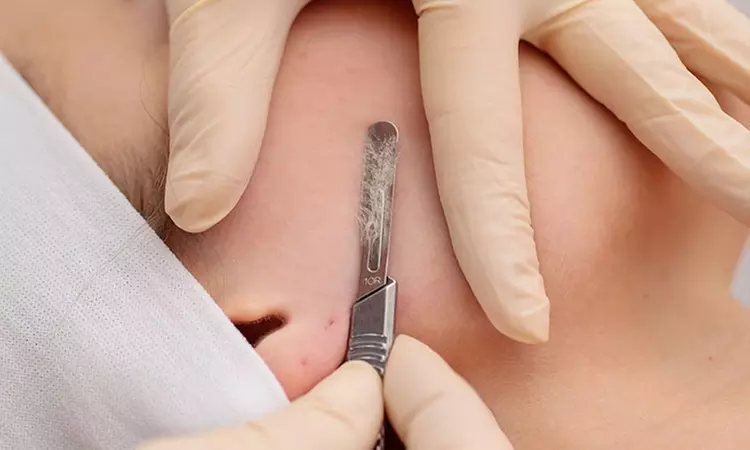 Reveal a brighter complexion with Lasertique Spa's dermaplaning treatment, smooth and glow up to 56% off. - Primary Image
