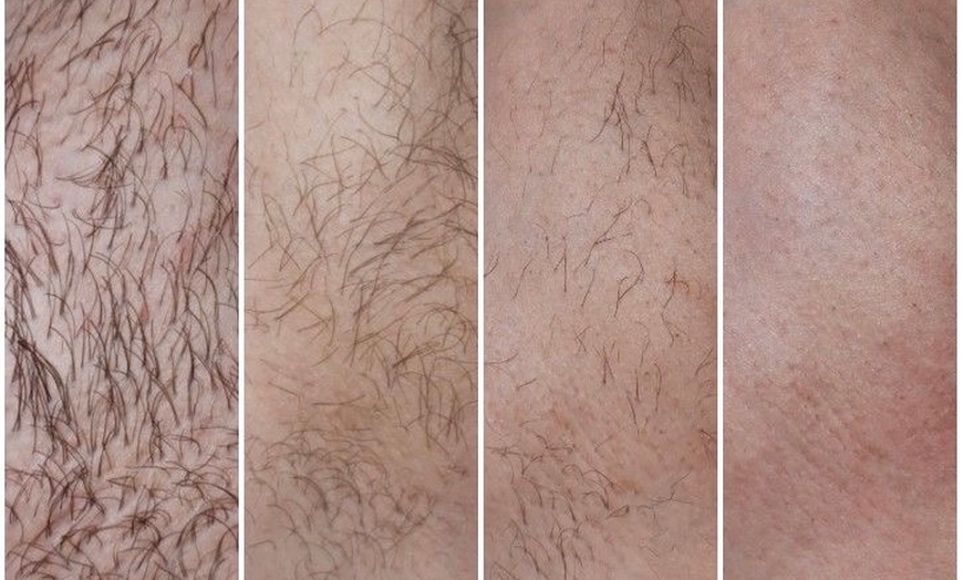 Image 1: Up to 87% Off on Laser Hair Removal at Aesthetics Care Med Spa