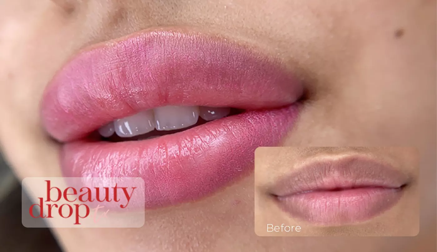 Up to 40% Off on Lip Enhancement at Beauty Drop TX - Primary Image