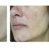 Image 6: Laser Skin Rejuvenation for Face, Neck, or Hands