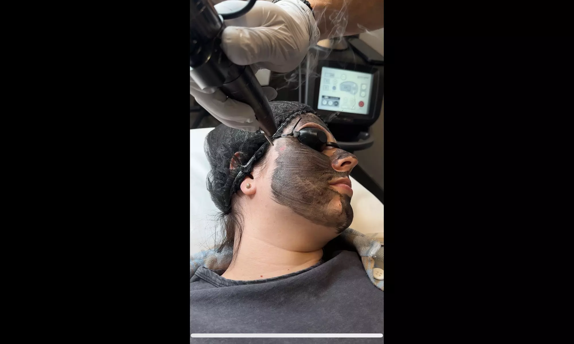 Glow Up with Carbon Laser Peel for Face & Neck