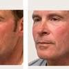 Image 9: Celebrity-Coveted Cheek Pop or Snatched Jawline with PDO Threads at No Pain All Gain Spa (Up to 30% Off)
