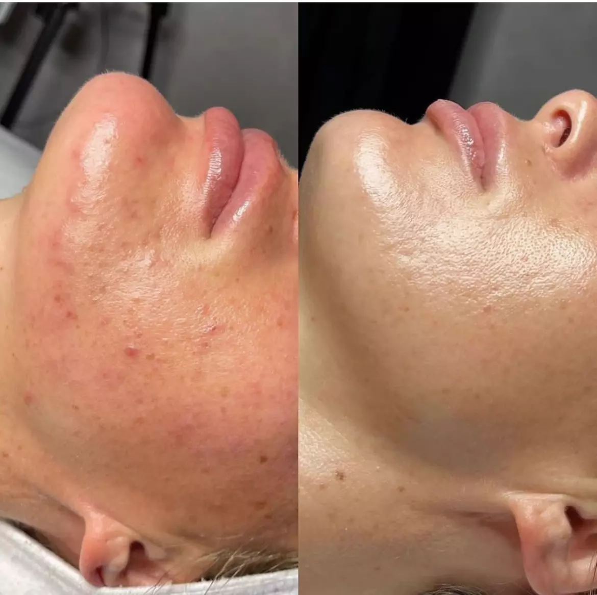 Up to 37% Off on Micro-Needling at Revive Esthetic