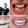 Image 1: Up to 91% Off on Dental Implant / Corona / Veneer at ImplantWIDE Skokie