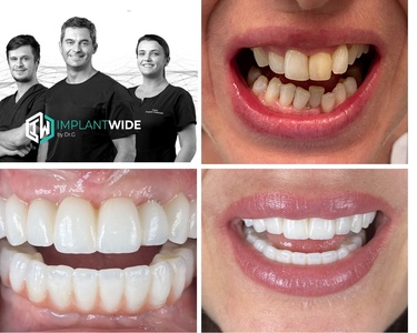 Full Arch Mouth Dental Implants All-on-4,6, X Zirconia Bridge Consultation with CBCT 3D Scan and Virtual Smile Design - ImplantWIDE Skokie