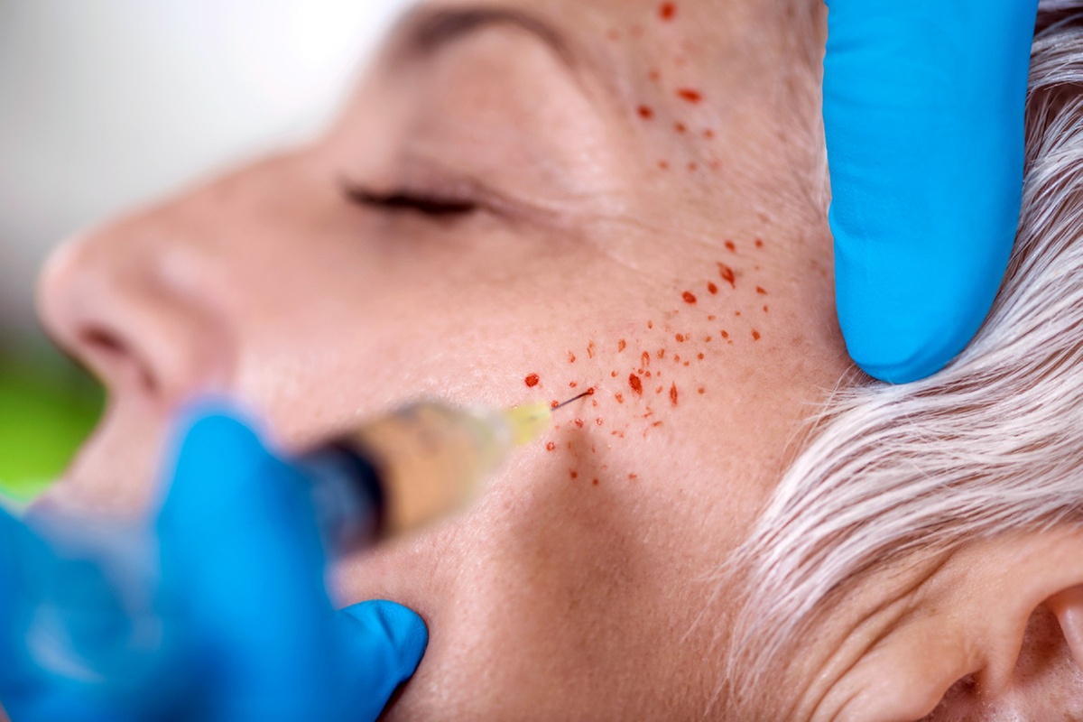 Revitalize with PRP Facial Microneedling and Injections