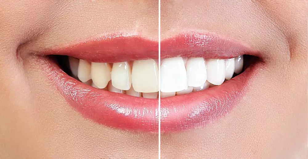 Achieve a Sparkline Smile with 1 Teeth Whitening Treatment with Optional Exam, X-Rays & Cleaning (Up to 40% Off) - Second Medium