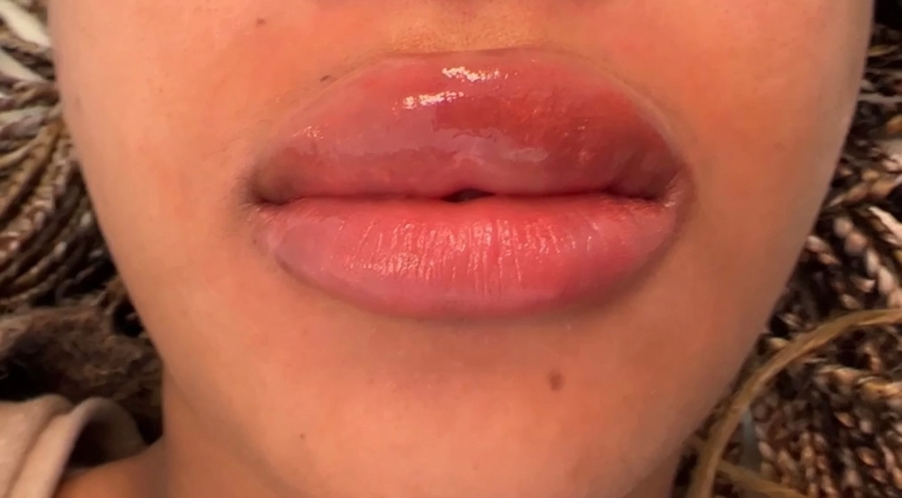 Enhance Natural Beauty with Lip Neutralization Treatment