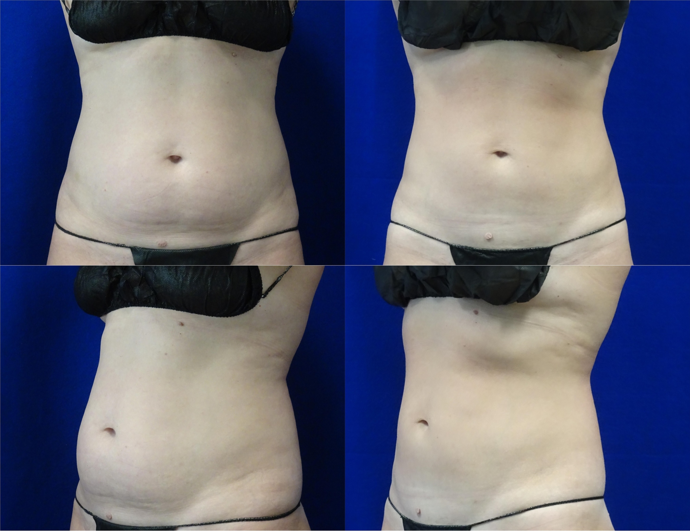 Experience Coolsculpting with a Personalized Consultation