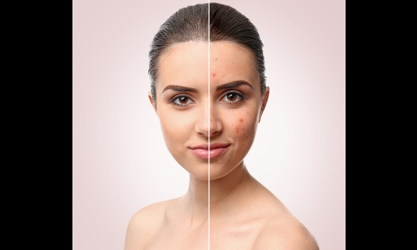 Clear Skin Journey with Tailored Acne Treatments