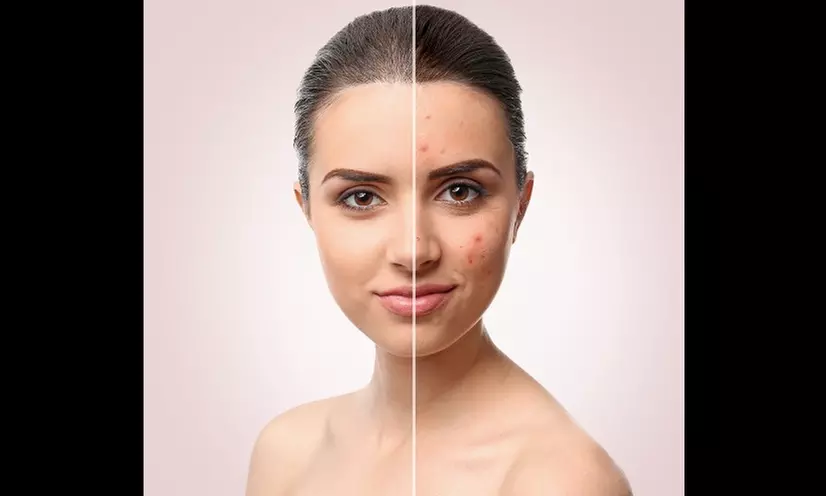 Experience Darling Skincare's Personalized Acne Treatments, Offering Options for One or Two Sessions, up to 46% Off - Primary Image