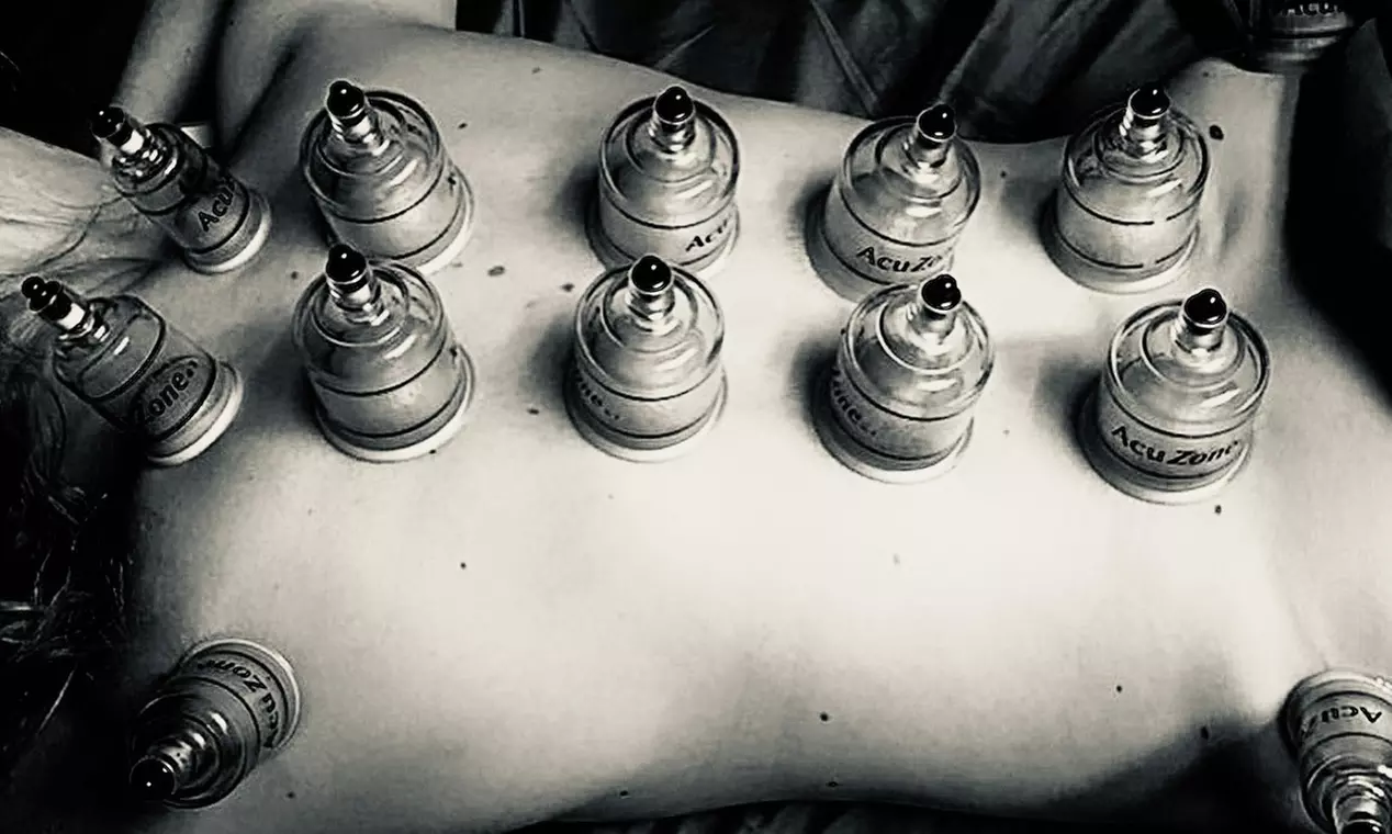 Up to 42% Off on Cupping at Sports Massage Spa - Primary Image