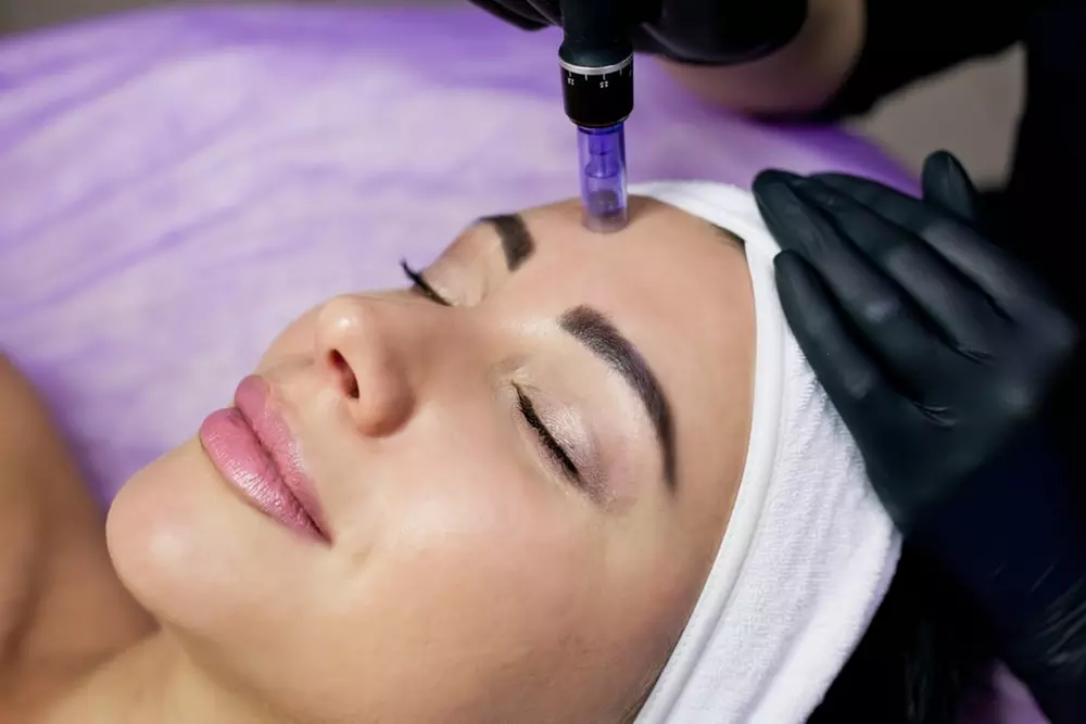 Revitalize with Aesderma Medspa's Face and Neck Microneedling Options up to 65% Off