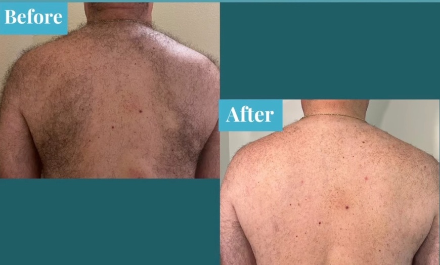 Image 3: Laser Hair Removal: Six Treatments for Various Areas