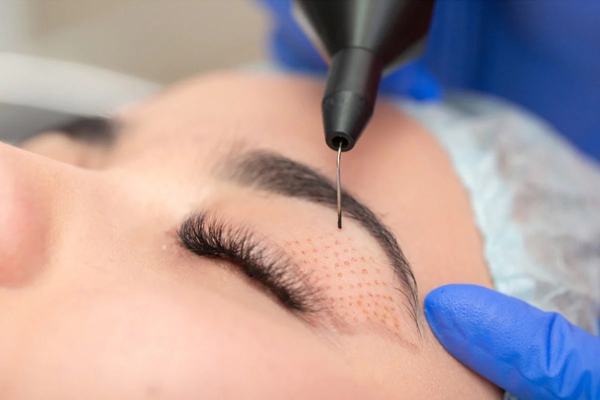 Plasma Fibroblast Treatment for Eyelids and Face Options