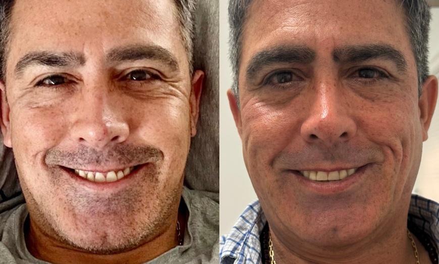 Image 6: Revitalize with 1 or 3 Non-Surgical Facelift and Anti-Aging Treatment