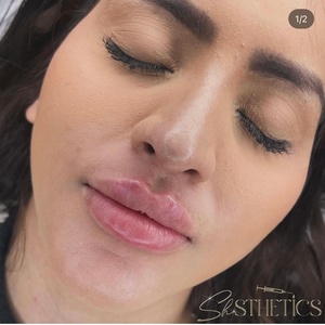 0.5 ml Lip Filler Treatment