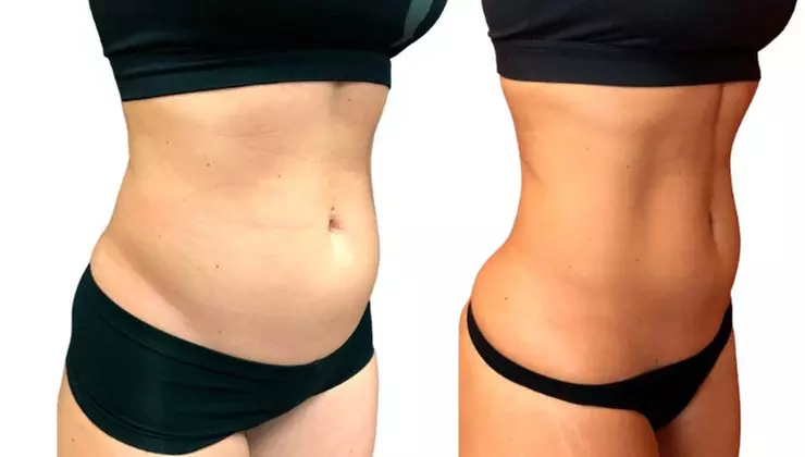Non-Invasive Laser Lipo Treatments for a Slimmer You