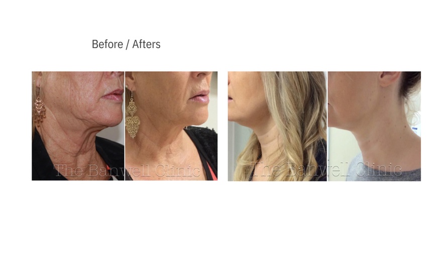 Image 4: Up to 52% Off on Facelift - Non-Surgical at All About You Clinic