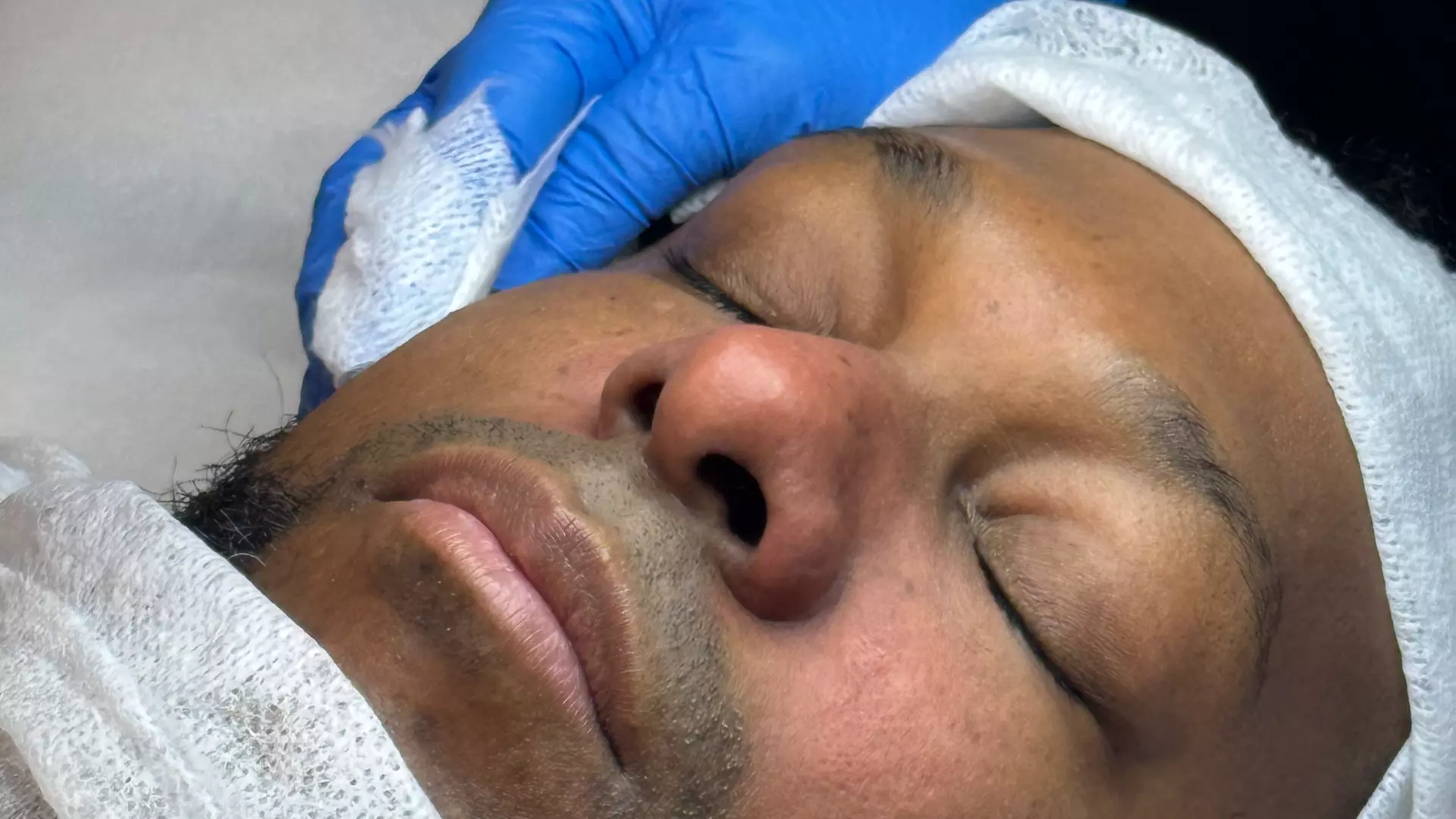 Up to 40% Off on Facial at Alta Aesthetics - Second Medium