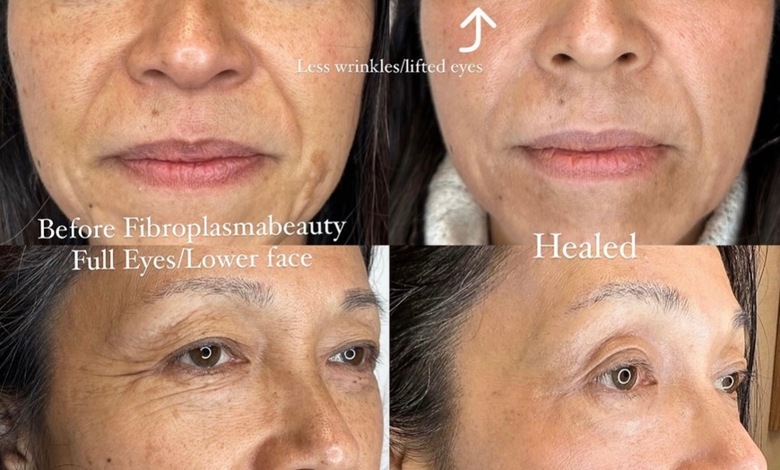 Image 4: Fibroblast Plasma Pen Lifts for Face and Neck