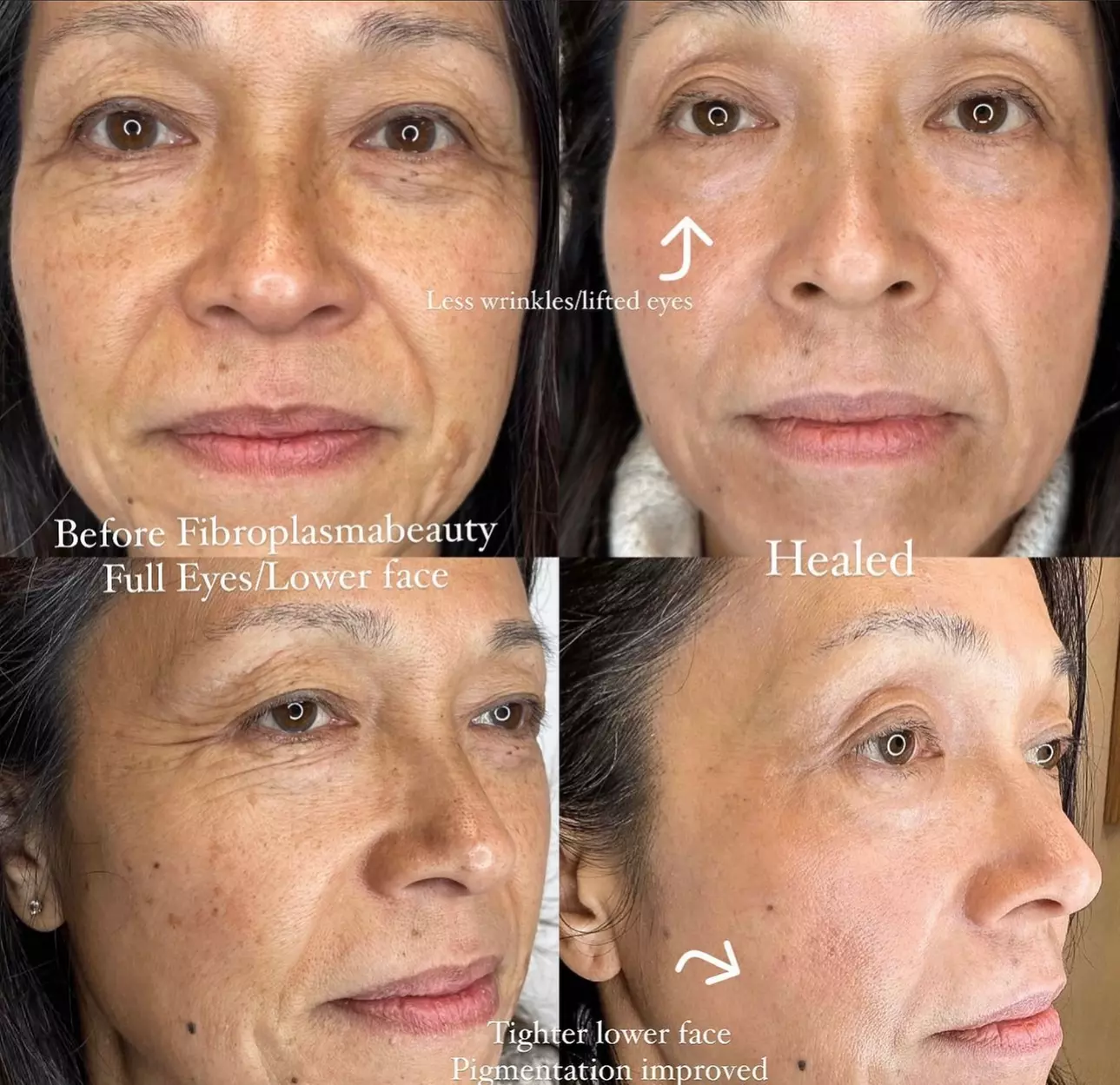 Fibroblast Plasma Pen Lifts for Face and Neck