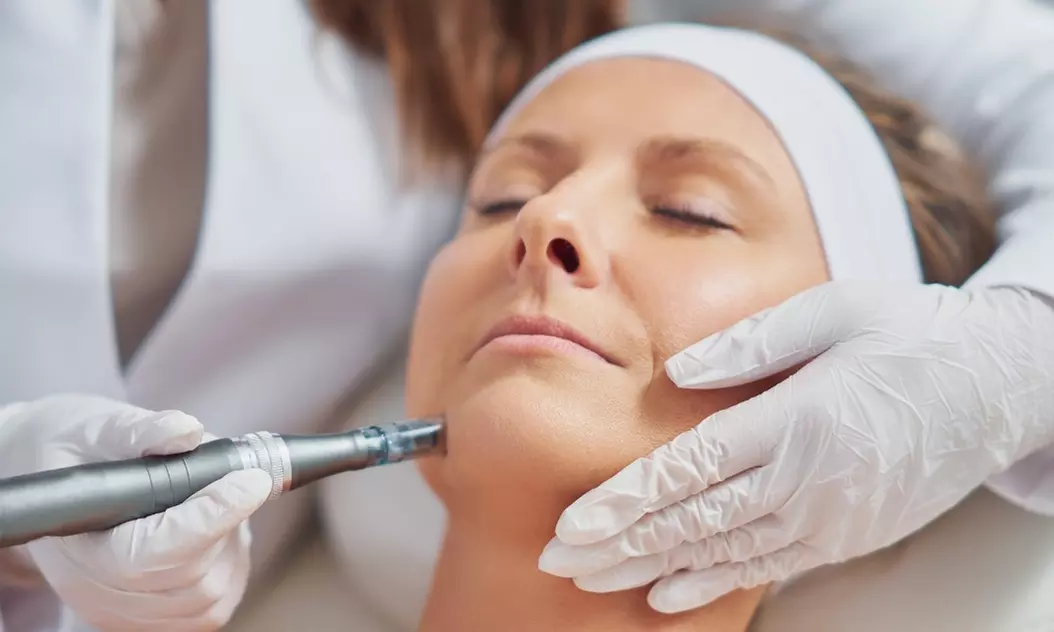Up to 56% Off on Micro-Needling at Golden Beauty - Primary Image