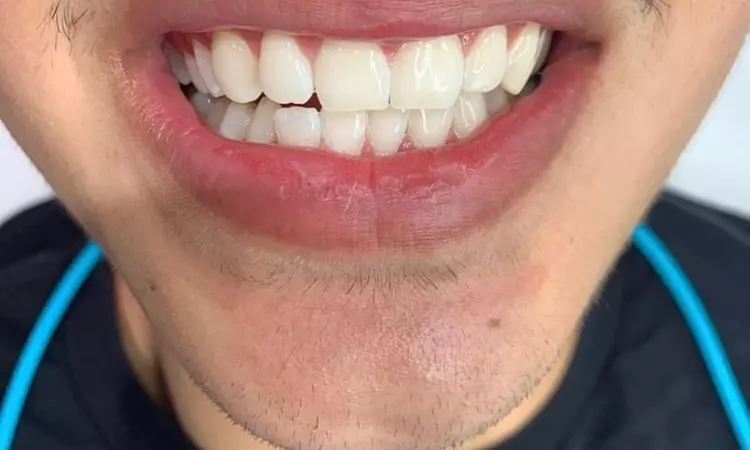 Up to 60% Off on Teeth Whitening - In-Office - Non-Branded at Daintee Wellness - Second Medium