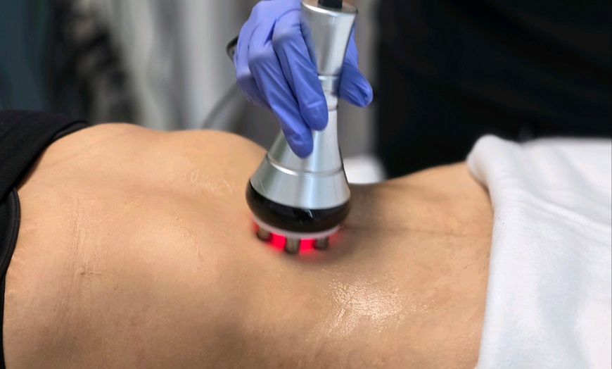 Image 1: Up to 75% Off on Cavitation at SoFlo Medical Center