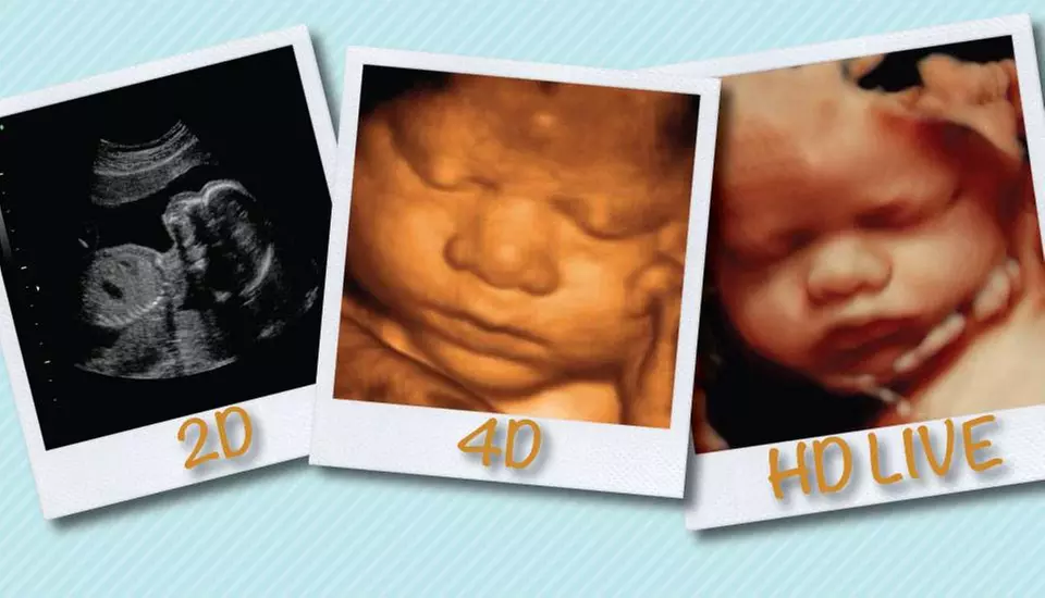 Experience the Joy of 3D/4D Ultrasound Sessions