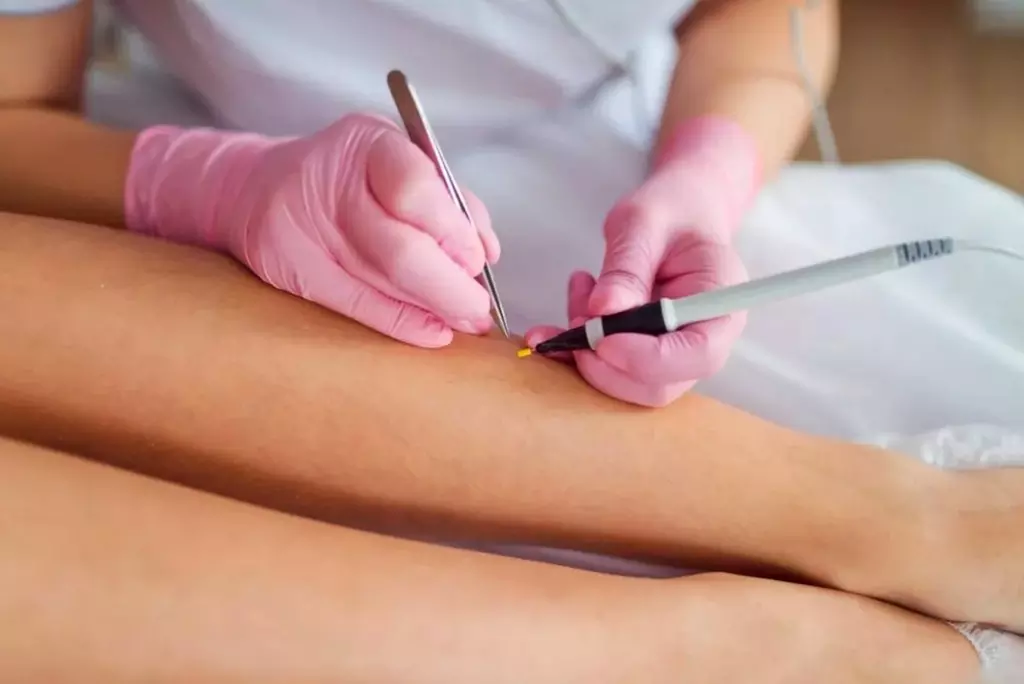 Up to 43% Off on Electrolysis at V&N MedLaser - Primary Image