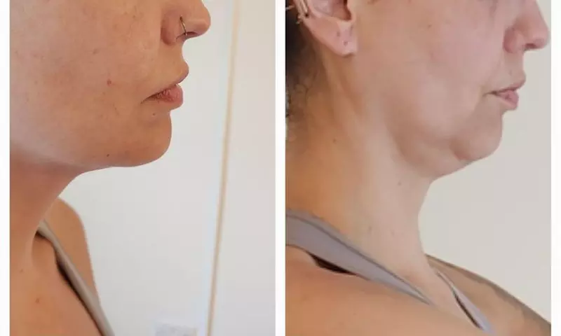 Up to 50% Off on Fat / Cellulite Reduction - Non-Branded at Noire Aesthetics