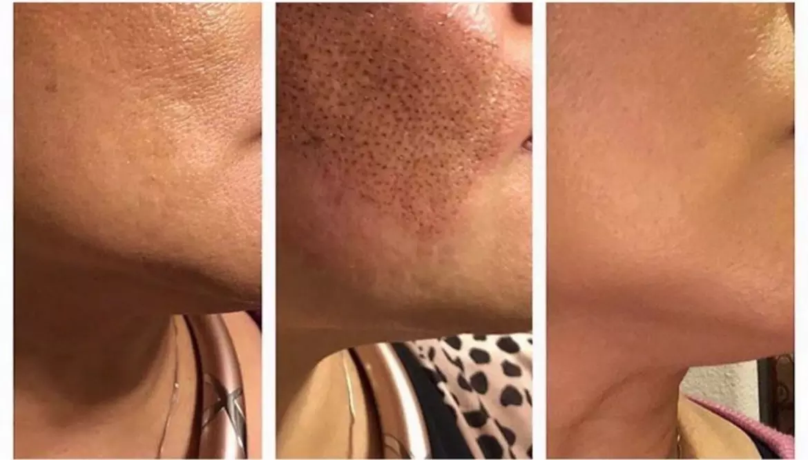 Up to 58% Off on Facial - PRP / Platelet Rich Plasma / Vampire at Derma Theory  - Primary Image