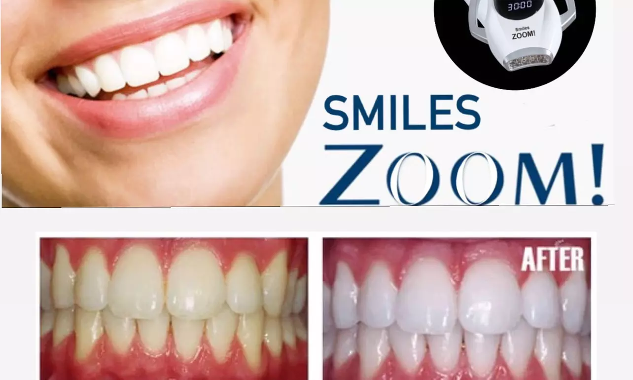 Up to 38% Off on Teeth Whitening - In-Office - Branded (Zoom, Brite Smile) at Zoom Smile - Primary Image