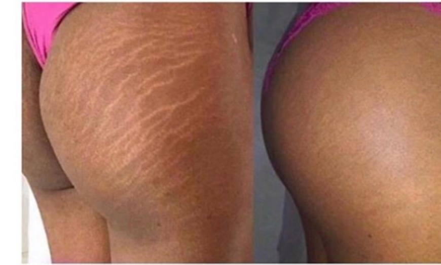 Image 3: Areola Tattoo Treatment, Scalp Micropigmentation Or Cheek Blush Tattoo