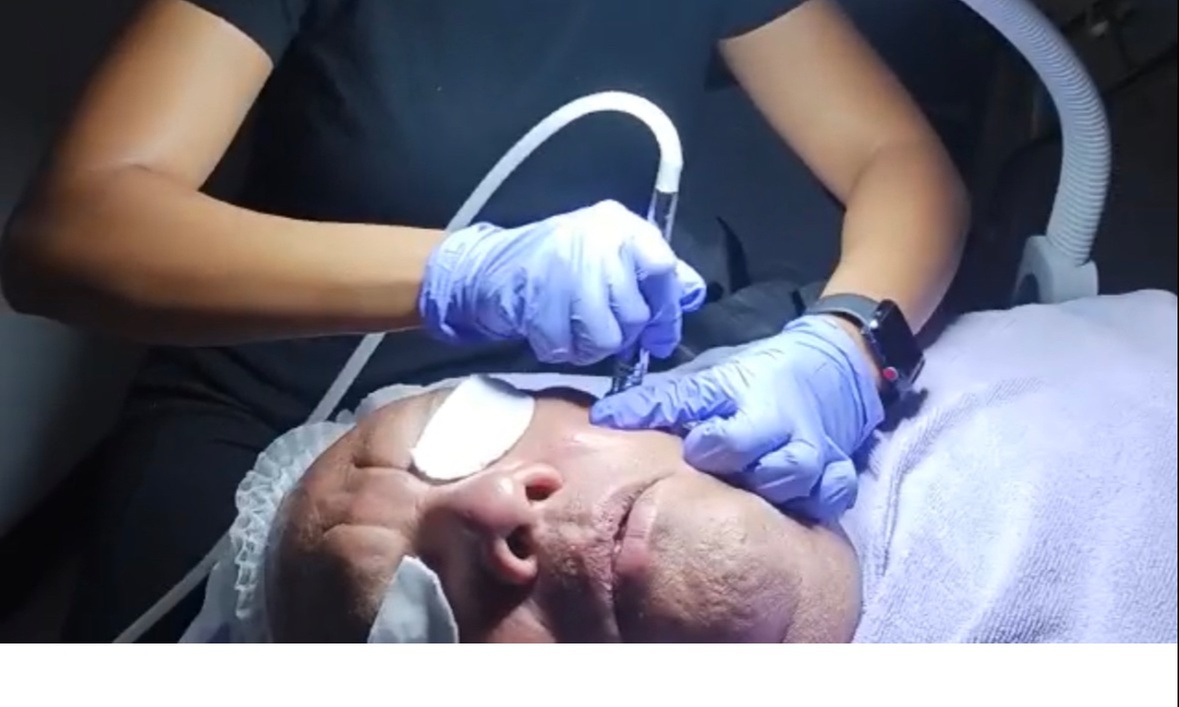 Up to 35% Off on Microdermabrasion at ThermaeSpa