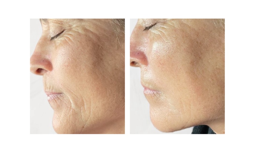 Image 1: Turn Back Time with the Power of BioRePeel at Rise Skin Spa