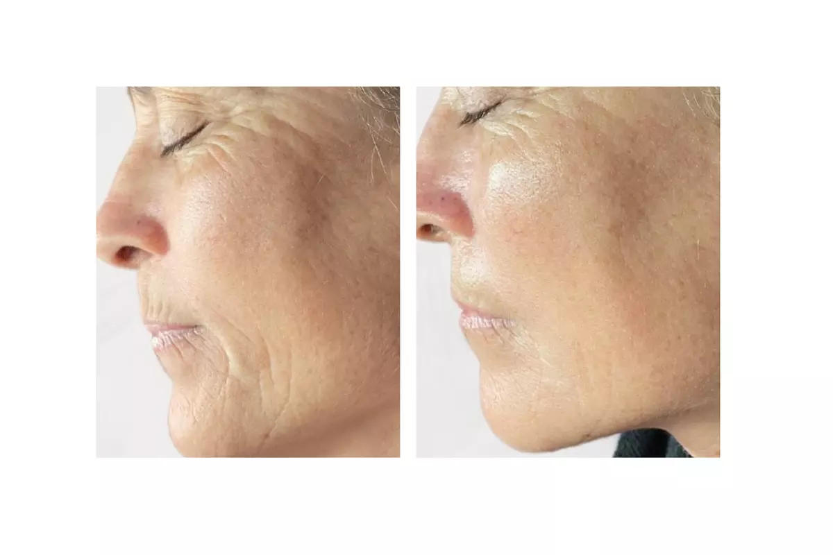 Turn Back Time with the Power of BioRePeel at Rise Skin Spa