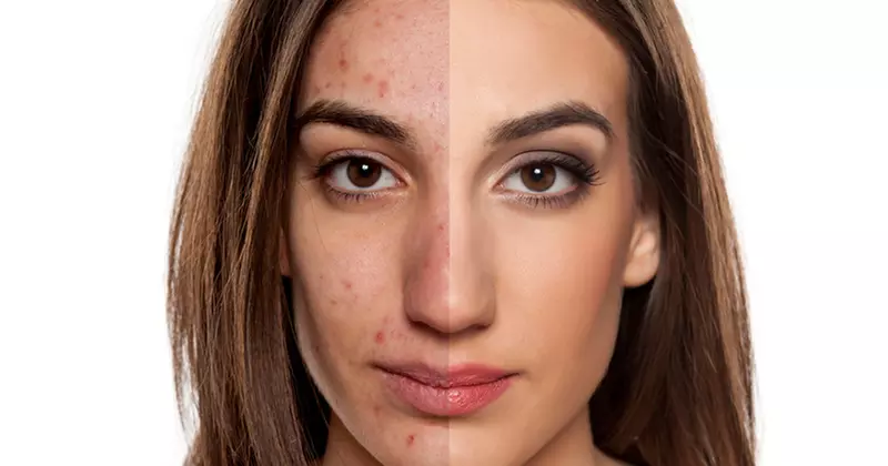 Up to 65% Off on Micro-Needling at Nadia