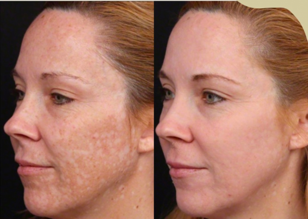 Up to 55% Off on Chemical Peel at Fit + Fuel