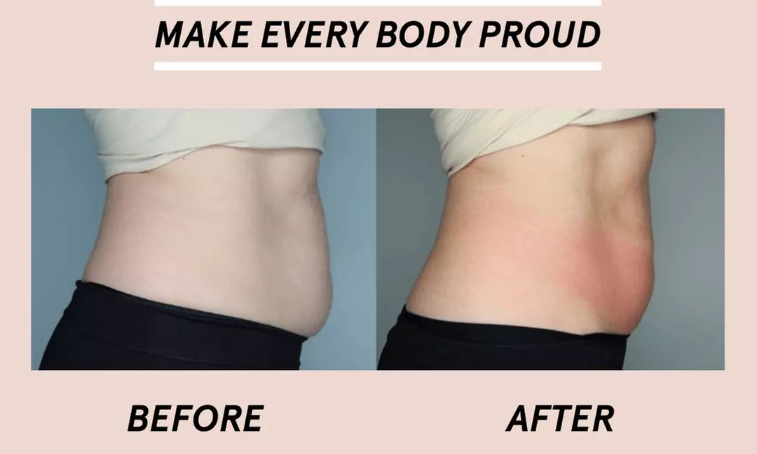 Up to 75% Off on Fat Reduction - Non-Branded at Body By Design - Primary Image
