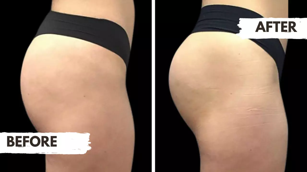 Discover Cordial Medical Spa's Nonsurgical Butt Lift with EMSCULPT up to 50% off - Primary Image