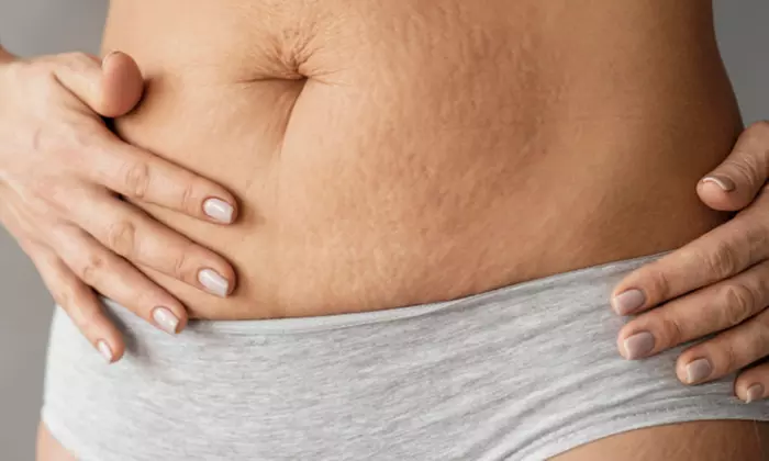 Discover Her Body Bar's Inkless Camouflage for Stretch Marks & Scars with up to 30% off - Primary Image