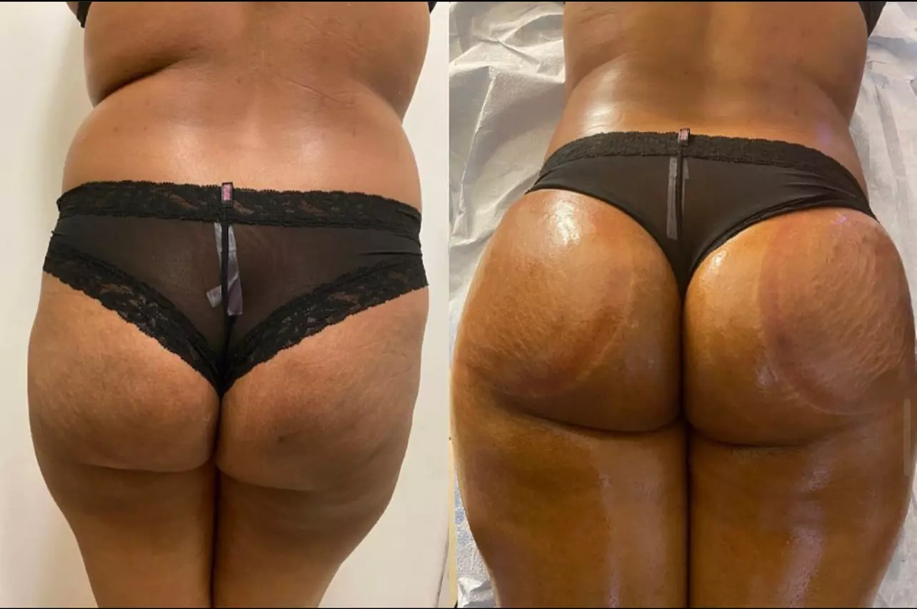 Body By Slay and More offers options for a non-surgical butt lift with Mega Cups and thermal treatment up to 39% - Primary Image