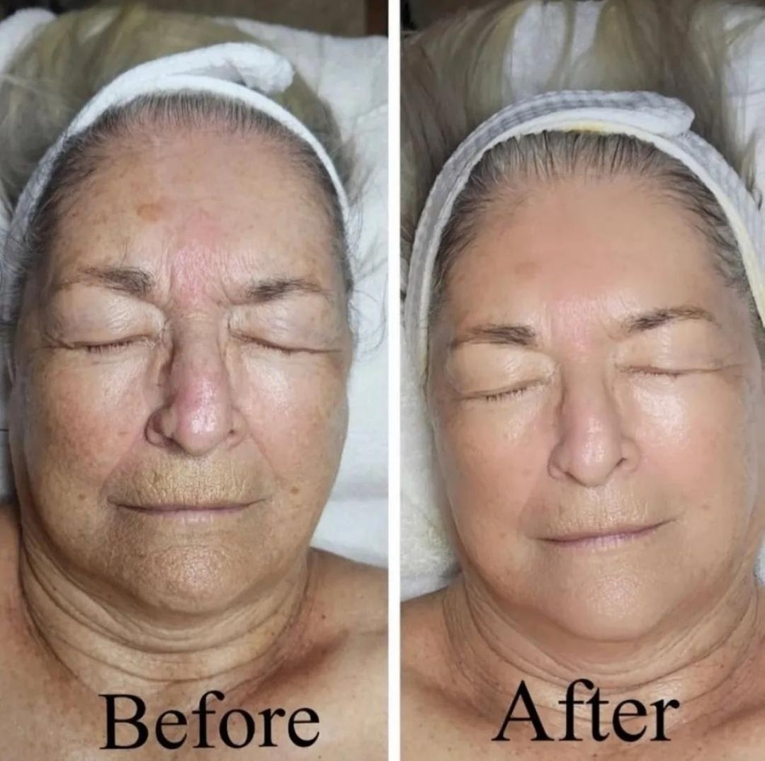 Rejuvenate Your Skin with a 60-Minute Diamond Peel Facial Microdermabrasion at Surf City Skin Care (Up To 60%)