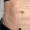 Image 3: Up to 71% Off on Cavitation at Extreme body sculpting