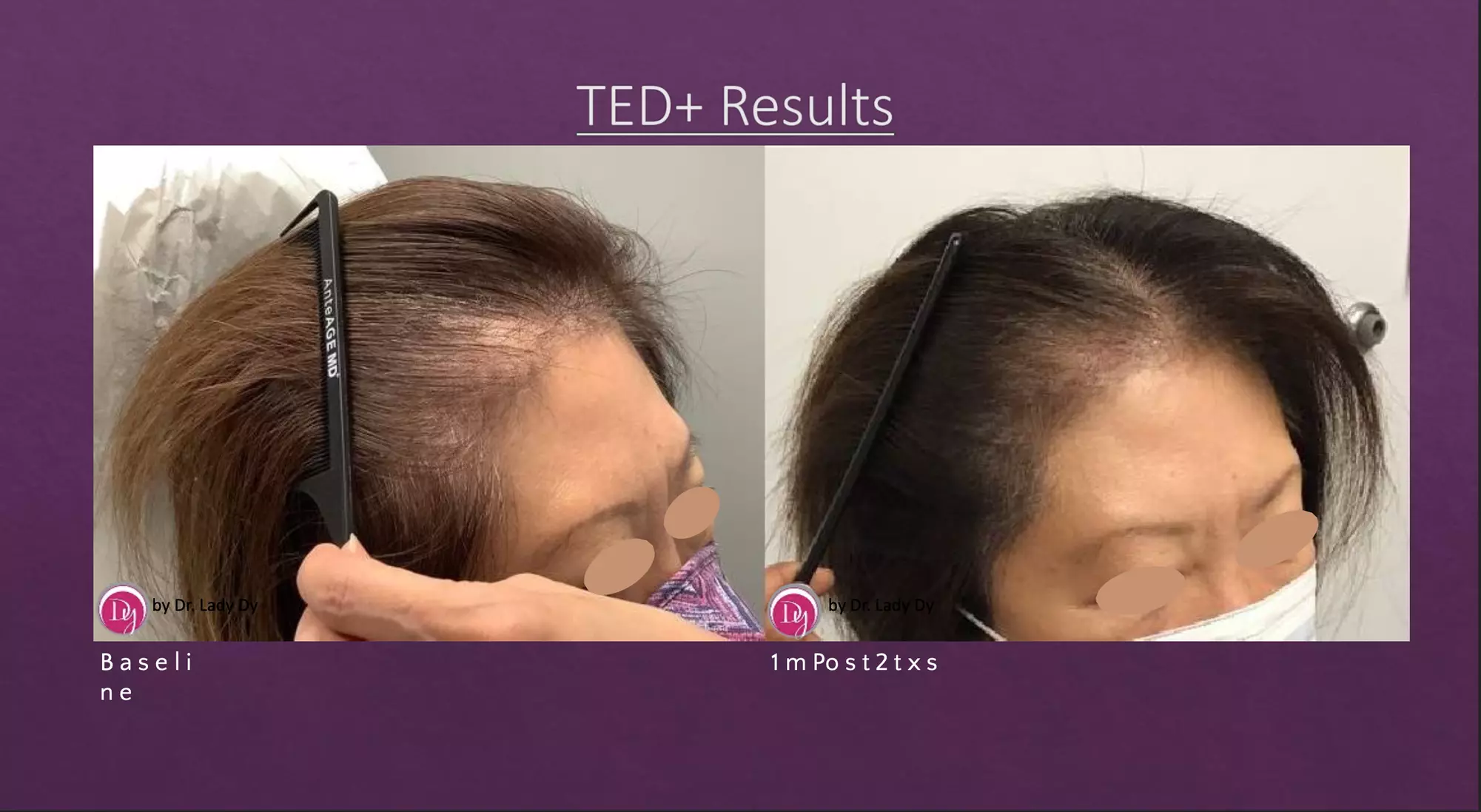 Up to 50% Off on Hair Restoration - Non-Surgical at HoustonOG - Second Medium