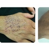 Image 3: Laser Skin Rejuvenation for Face, Neck, or Hands